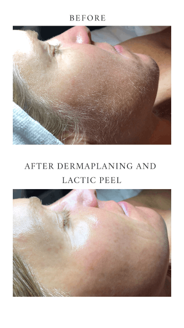 EXPRESS DERMAPLANING